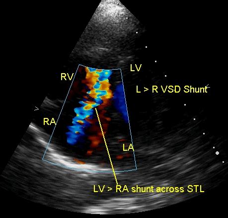 lv to ra shunt|LV – RA shunt – All About Cardiovascular System and Disorders.